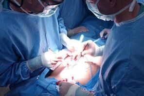 Realizar una operación para aumentar el pene