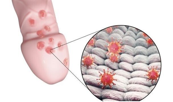 Alergia al gel para agrandar el pene