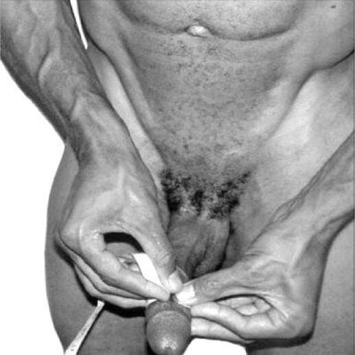 Medición del pene antes del agrandamiento.